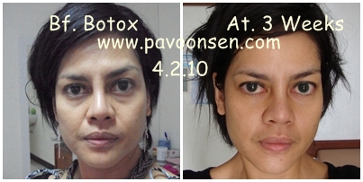 Up Date Botox ของป้าวุ้นเส้น ที่ฉีดมา 3 สัปดาห์จ้า