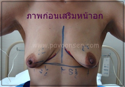 Review Mammoplasty หน้าอกที่เคยเหี่ยวย้อย ห้อยยาน กลับมาเต่งตึงเด้งดึ๋ง ได้ค่ะ