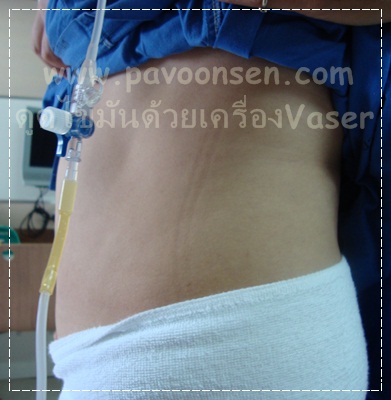 รีวิว เมื่อคุณหญิงใหญ่ไปดูดไขมัน ด้วย Vaser