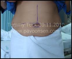 รีวิว เฮเลน ตัดไขมันหน้าท้อง แก้ไขท้องลาย Tummy Tuck