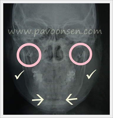 รีวิว นู๋คำหล้า ทำหน้าวีไลน์ V line วีเชฟ ตอนที่ 1