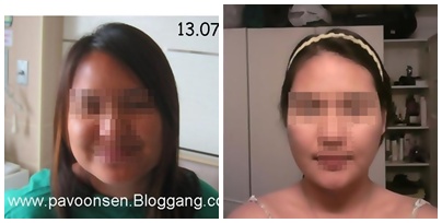 ป้าวุ้นเส้น รีวิว ตัดกราม น้องจอย สุดเริ่ด ละเอียดยิบ พร้อมภาพประกอบ