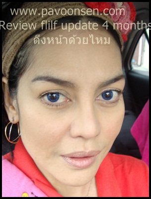Update หลังดึงหน้าด้วยไหม flilf ผ่านไป 4 เดือน