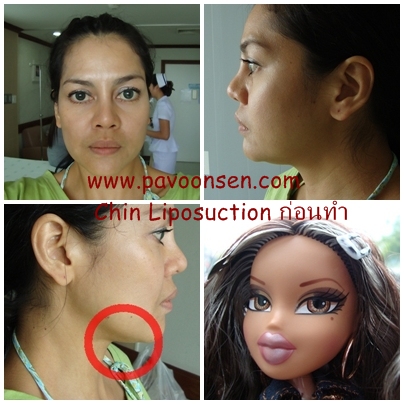 Before and After ดูดไขมันใต้คาง
