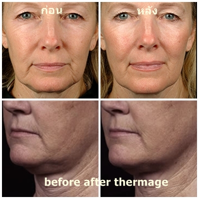 before after thermage ภาพก่อน หลังทำเทอร์มาจ
