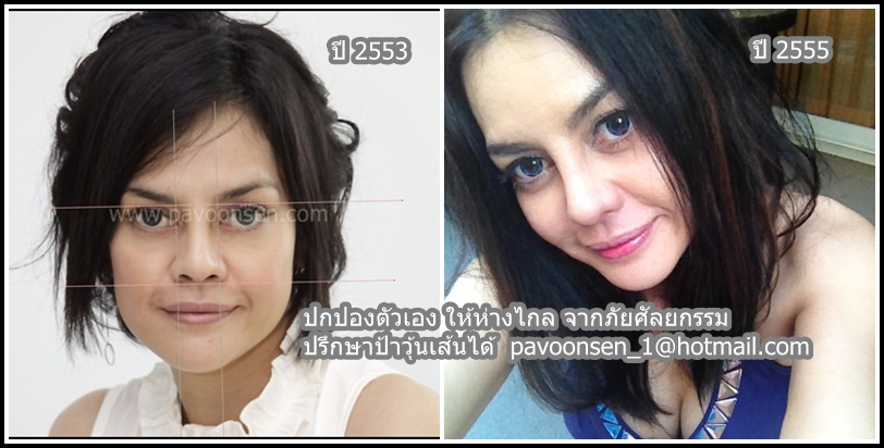 เกร็ดกรุ๊งกริ๊ง :pavoonsen.com ต้องการผ่าตัดดึงหน้าในวัย 50 ปี