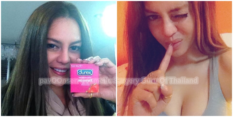 เคยทำนมที่อื่นมา พอจะมาตัดกรามกับป้าวุ้นเส้น ดันเป็น HIV ซะงั้น
