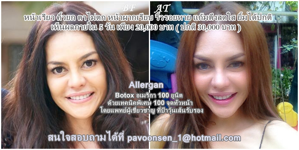 โปร Botox ” เรียว รับ น้ำ ” สวยทันสงกรานต์นี้แน่นอน …#plubpla pavOOnsen