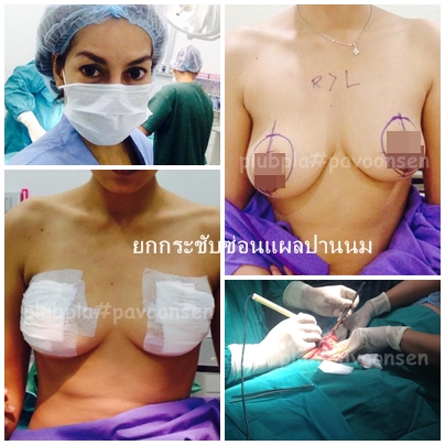 ยกกระชับหน้าอกที่หย่อนคล้อย Breast Lift