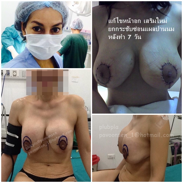 Breast impant แก้หน้าอกเดิม แล้วเสริมหน้าอกใหม่