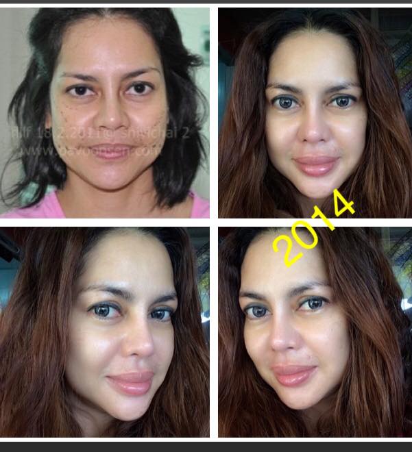 ป้าวุ้นเส้น ดึงหน้าแบบ flilf ด้วยไหม Silhouette ซิลลูเอท ไม่ต้องผ่าตัดใหญ่ลดวัยได้ 10 ปี มาแล้วจ้า