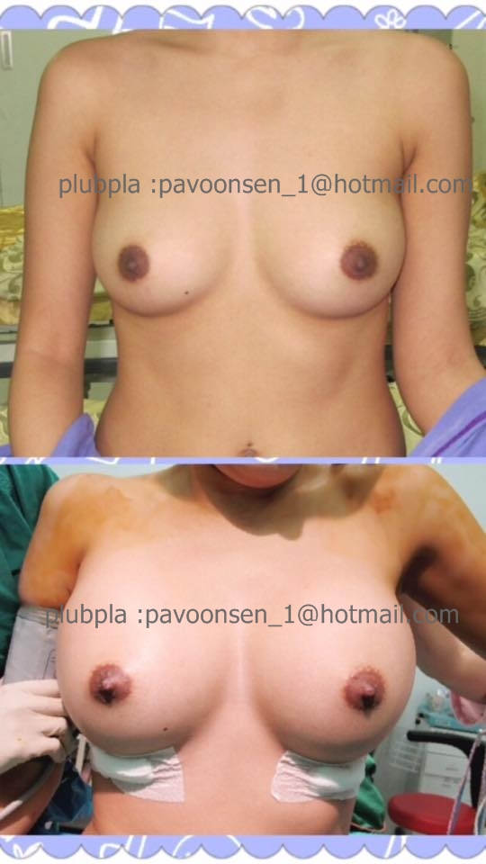 เสริมหน้าอก แบบปลอดภัยป้าวุ้นเส้นอยู่ในห้องผ่าตัด ” ฟรี “