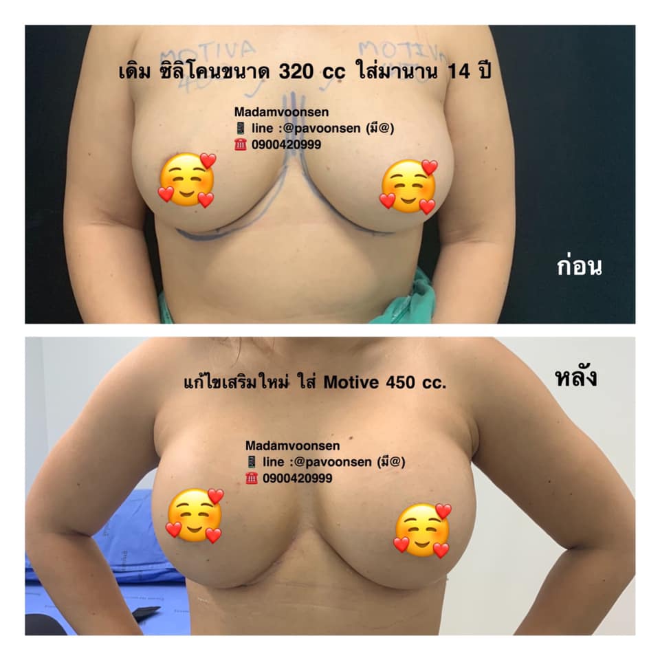 เสริมหน้าอกด้วยซิลิโคน MOTIVA ดียังไง