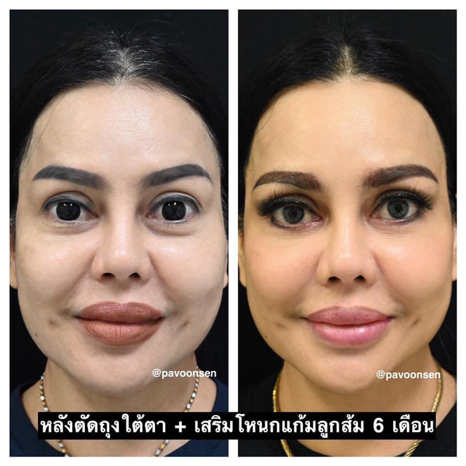 รีวิวเสริมโหนกแก้มลูกส้มถาวร และเก็บถุงใต้ตา  6 เดือน