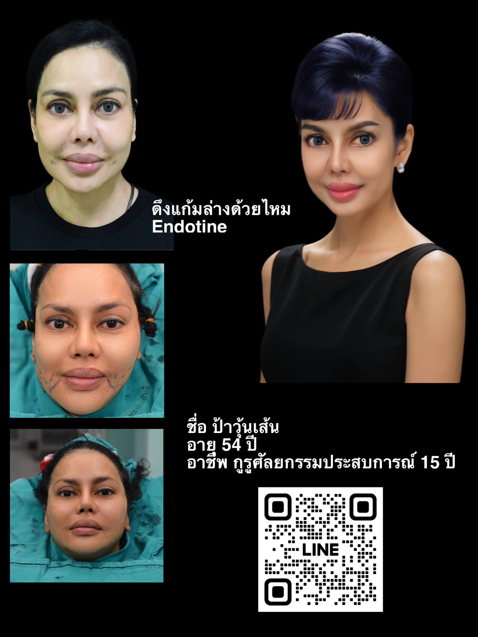 ป้าวุ้นเส้นดึงหน้าด้วย Endotine ในวัย 50 +