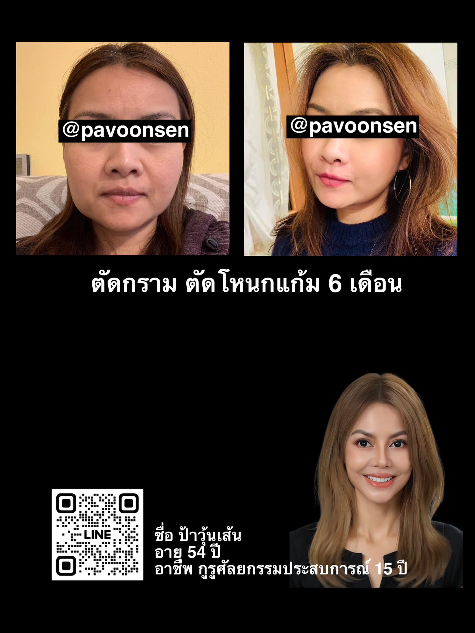 ตัดกราม ตัดโหนกแก้ม หมอสุทัศน์