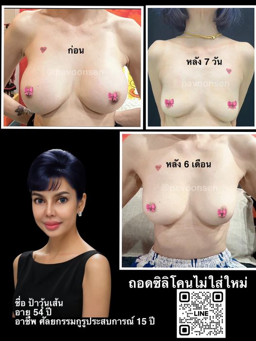 เอาหน้าอกออก (ซิลิโคนหมดอายุ ) ไม่เสริมใหม่