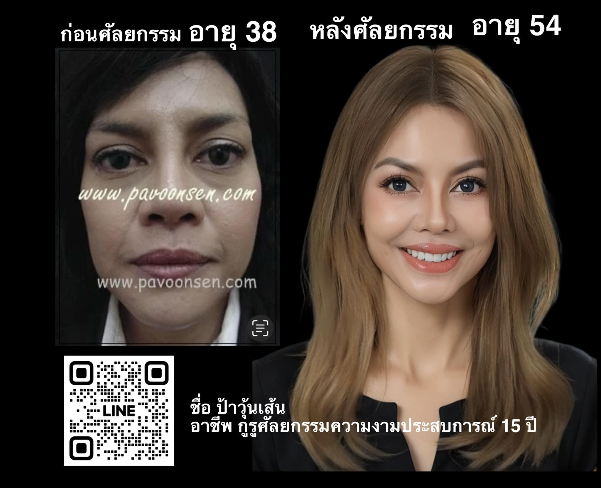 ป้าวุ้นเส้น อายุ 54 ปี กูรูศัลยกรรมความงามประสบการณ์ 15 ปี