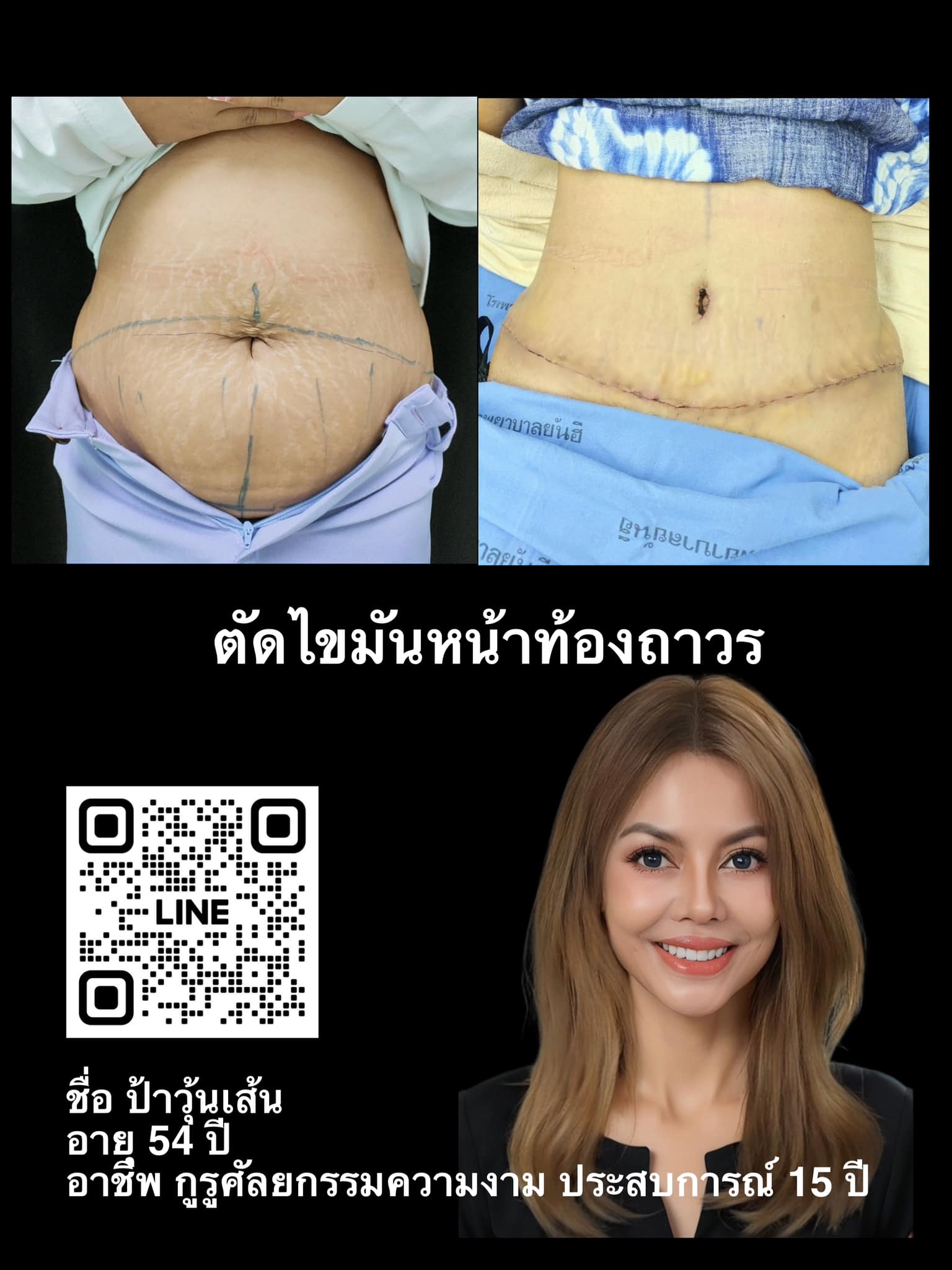 สร้างรูปร่างใหม่ ตัดไขมันหน้าท้อง แก้ท้องหย่อน ท้องลาย